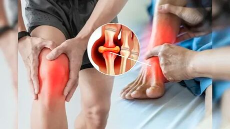 Icexin jel uygulamasına uygun cilt bölgeleri (dizler, dirsekler, sırtın alt kısmı)