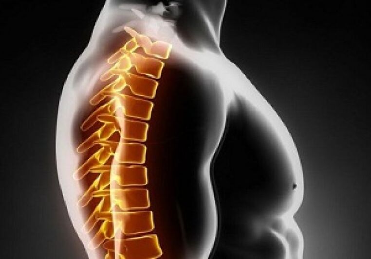 Torasik osteokondroz sırtın ortasında ağrı ve rahatsızlığa eşlik eder