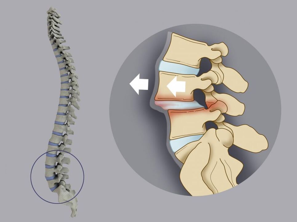 Bel ağrısının bir nedeni olarak vertebral yanlış hizalama
